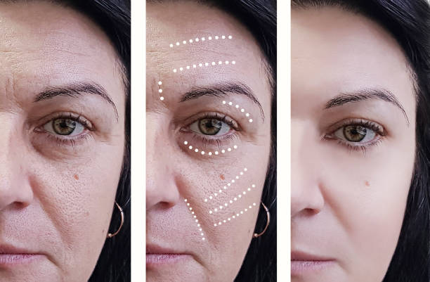 woman wrinkles before and after treatments retouching