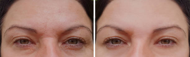 woman wrinkles on face before and after cosmetic procedures