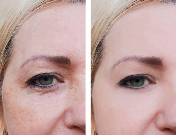 face woman wrinkles before and after pigmentation