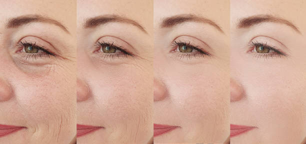 woman face wrinkles before and after treatment