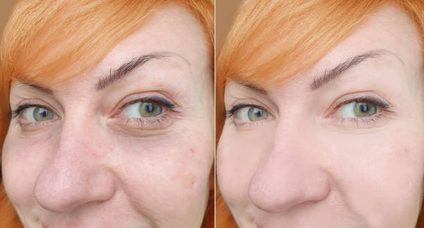 woman face wrinkles before and after treatment