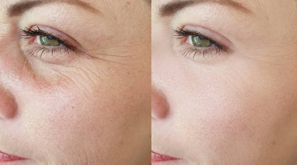 woman face wrinkles before and after treatment collage