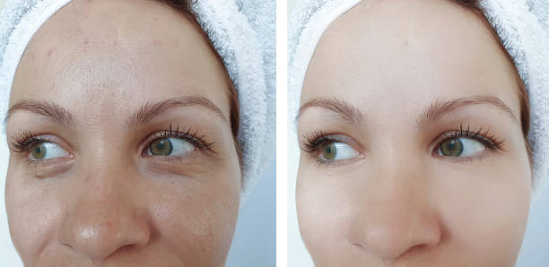 woman wrinkles face before and after treatment