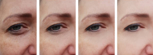 woman face wrinkles before and after correction