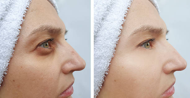 female eyes wrinkles before and after treatments