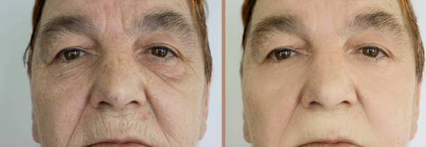 woman face wrinkles before and after treatment