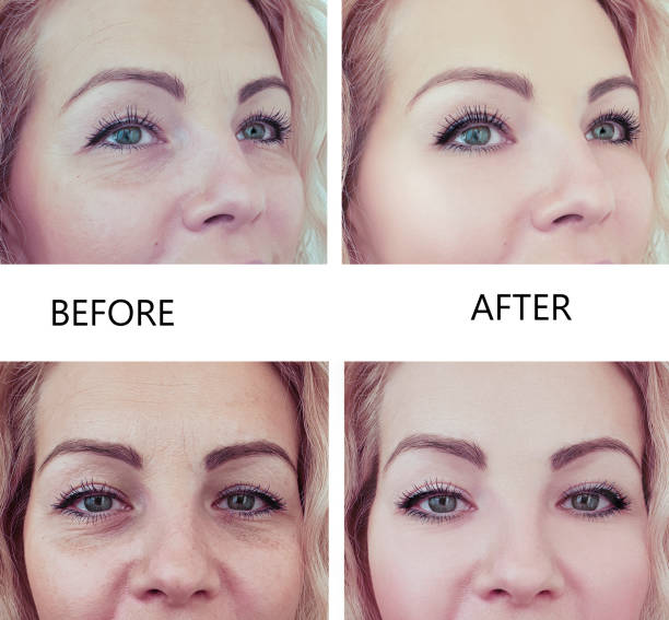 woman wrinkles before and after the procedure