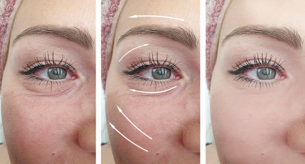woman wrinkles face before and after correction procedures