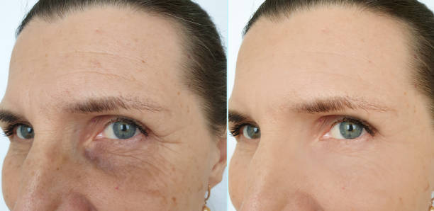 woman face wrinkles before and after treatment