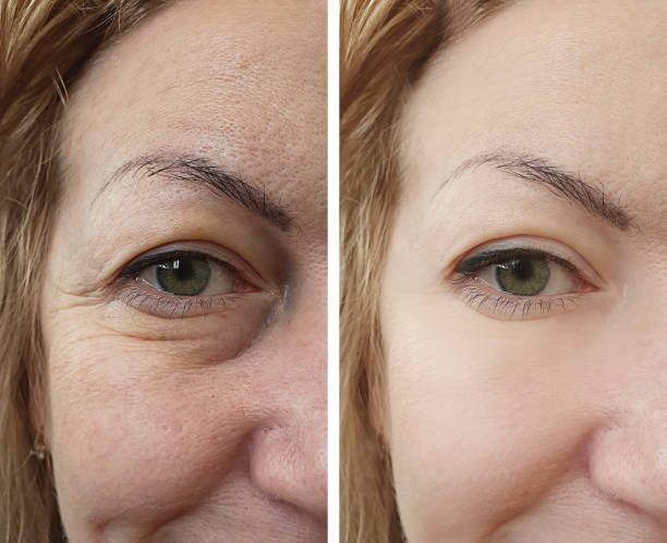 woman face wrinkles after treatments