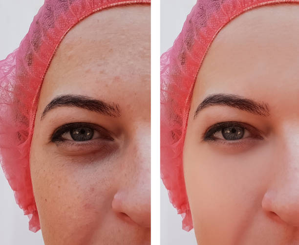beautiful girl wrinkles on face before and after procedures, pimples