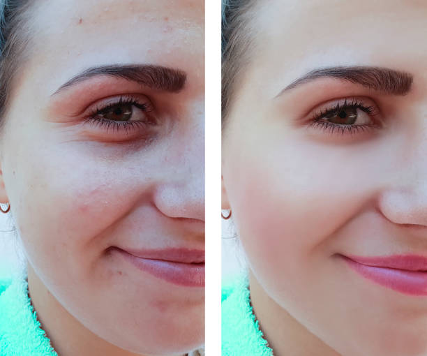beautiful girl wrinkles, acne on the face before and after procedures