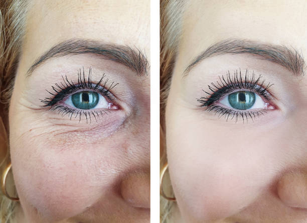 woman face eyes wrinkles before and after procedures
